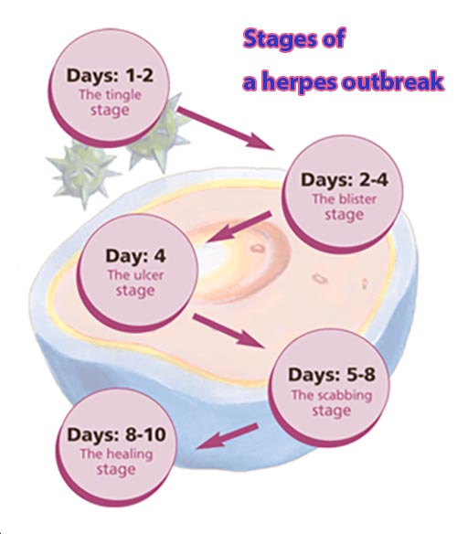 herpes stages pictures,herpes outbreak timeline